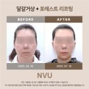 포레스트의원 | 50대 안면거상술 후기, 달걀거상술과 포레스트 리프팅 임상 사례