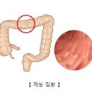 게실 [diverticulum, 憩室]과 게실염[diverticulitis, 憩室炎] 이미지