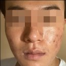 명 한의원 | 여드름전문한의원 다녀본 후기, 자국 때문에 시작한 관리 과정