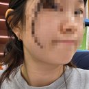 정한섬유 | 이중턱 지방흡입 &amp; 근육묶기 수술 후기(1일차->한달차) (통증,바본,한달차)