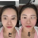 연세센스의원 | [ 대구 ] 동성로 피부과 연세바비의원 인모드fx 풀페이스로 팔자주름 없앤 리얼후기
