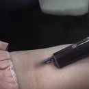 셀팅의원 | 셀팅의원 셀아이 시술이란? (ft. PRP주사에 맞춤 시술을 더하다.)