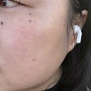 금손한의원 | 강남역 주근깨제거 피코토닝레이저 내돈내산 (3회차/한달 후기)