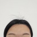 아우름의원 | 아우름의원 눈썹반영구제거 2회차 썰푼다