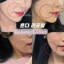 이뻐진개 | 부산 서면 온다 리프팅 | 솔직후기&amp;통증,효과