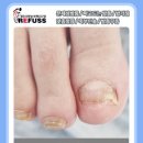 레푸스인천부평씨지브이(CGV)점 | 청천동 발톱무좀 관리 발 건강 관리의 중요성 &#34;레푸스부평CGV점&#34;