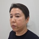 엄마의 집 효도급식소 | 청담피부과 쥬브젠자가진피재생술 엄마 팔자주름 제거 효도시술 내돈내산