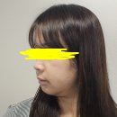 임회면 십일시장 | [교정일기10] 서울대 치대 양악수술 1일차~9일차 후기