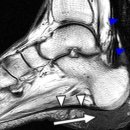 heel fat pad의 생체역학적 기능. mechanical properties and clinical applications 이미지