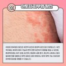 남향한의원 | 끝나지 않은 습진,화폐상습진