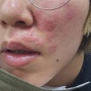 복음안과의원 | 30대 대상포진 7일차 후기.. ㅠ