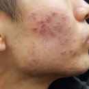 달아한의원 | 얼굴흉터 전문 한의원 시술 방법 후기