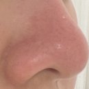 코다남 | 코피다 남양주 블랙헤드 전문점 호평동피부관리 남양주블랙헤드제거 후기