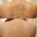 아루아 에스테틱 | 동탄등필링 아루아에스테틱 로즈필 2회 후기(사진많음)
