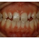 치아성형 | 앞니성형 | 급속교정 - 벌어진치아 빠르게 완성 이미지