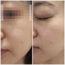 예쁘다 개 | 경기광주 피부관리 [예쁘다에스테틱 광주점] 피부톤업에 효과좋은 레이저관리 후기