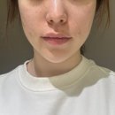 청담더맥한의원 | 내가 느낀 레디어스 효과, 부작용 솔직후기(feat. 청담아르티의원)