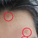 국홍일국정표피부과의원 네이버블로그