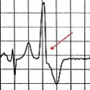 Premature ventricular contraction 이미지