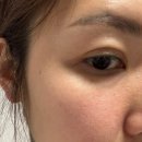 메이린의원 | 메이린의원 송도점 BBL레이저(+3주차) 내돈내산 후기