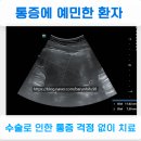 자궁근종통증 수술 부작용 걱정 없이 치료 근종7.5Cm 치료 사례