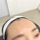 동성길 | 제주 헤어라인 왁싱 m자 이마 탈출 후기 에피브