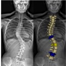 나 자세가 안좋아서 척추측만증 생겼잖아ㅠㅠ 과연그럴까? 이미지
