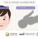 근육간대경련[myoclonus] 이미지