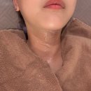 목동피부과 목주름필러 오마쥬넥 4회 후기