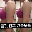 파리바게뜨 간석오거리점 | 인천피부관리l 비타C스킨갤러리에 팔뚝살 지방냉동분해술 쿨핏 받으러 재방문한 후기