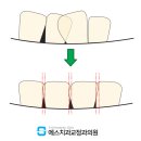 블랙트라이앵글 교정으로 앞니 치아 사이 틈 개선 후기