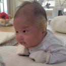 더블유이비인후과의원 | 광주 아기 귀교정 3주만에 성공한 후기