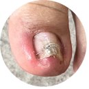 레푸스서면점 | 서면 '레푸스[REFUSS]' 문제성 발톱 파고드는 발톱 시술 후기