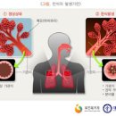 기관지 천식 검사 치료 기관지 천식 기침 원인 증상 기관지 천식 음식 이미지