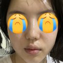 만성인셀덤