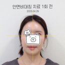 삼성중앙역,청담역 안면비대칭 치료 턱관절 소리 줄고, 얼굴 비대칭도 개선된 한의원 치료 후기
