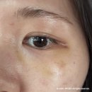 파인약국 | 다크써클 없애는법으로 유명한 리투오 파인 받고옴!(+ 신논현 피부과 가격 추천 )