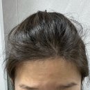 분당맥스웰의원 | 산후 탈모치료 맥스웰 16회차 후기