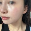 교동초등학교 | [강릉에스테틱] 칙칙한 피부에 플라즈마 관리로 힐링 한스푼! &#39;고율에스테틱&#39; 후기