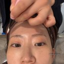 수지맑은피부과 | 수지구청역피부과 글래스스킨부스터 포텐자 콜라스터 효과 후기