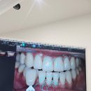 [뷰티] 레브치과의원 | 강남치아미백 | 신사치아미백 | 원데이 치아미백 | 당일 치아미백 | 치아미백 가격