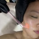 셀프피부미용(꿀피부만들기) | 명지피부관리 타임에스테틱에서 플라즈마 받고 온 후기