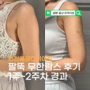 멍이옷 | 인천웨딩다이어트, 팔뚝 무한람스 후기 1~2주차 (+멍, 붓기, 통증)
