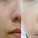 운남피부과의원 | 압구정 모공축소주사 밀크주사 후기