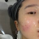 필바이오 | 전주 송천동 [원스킨케어] 바이오필링 퀵필 관리 후기