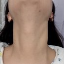 갸름해진 작은얼굴로 만족도 높은 가산피부과 인모드 후기