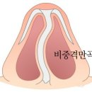 만곡 이미지