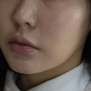 라임 | 울쎄라 피프라임 효과 후기 통증 붓기 다운타임 정리