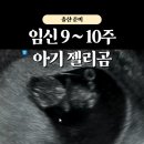 임신 9주차 10주차 증상, 초음파로 젤리곰 만나기