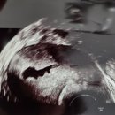 시엘병원 | 자궁 용종 제거 수술 후기/ 광주 시엘병원/ 자궁 용종제거수술 비용 실비 청구 수술비 청구